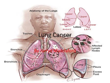 Lung Cancer By Jarryd Maddaford. How you get lung cancer Lung cancer is mostly given to people through smoking. 1 time out of 10 lung cancer is given.