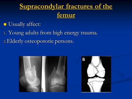 Supracondylar fractures of the femur Usually affect: Usually affect: 1. Young adults from high energy trauma. 2. Elderly osteoporotic persons.