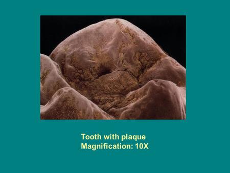 Tooth with plaque Magnification: 10X.