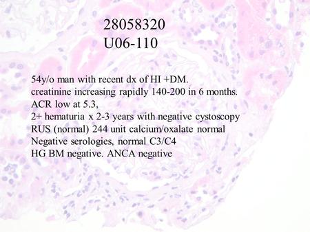 28058320 U06-110 54y/o man with recent dx of HI +DM. creatinine increasing rapidly 140-200 in 6 months. ACR low at 5.3, 2+ hematuria x 2-3 years with negative.