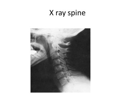 X ray spine.
