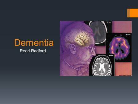 Dementia Reed Radford. What is dementia?  Dementia is a serious loss of global cognitive ability, beyond what might be expected from normal aging. 