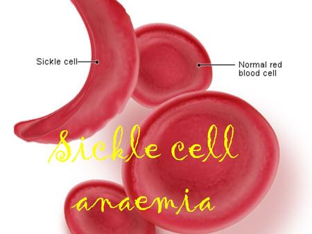 Sickle cell anaemia. ∞Its an inherited blood disorder that affects the production of haemoglobin that help carry oxygen around the blood. The body makes.
