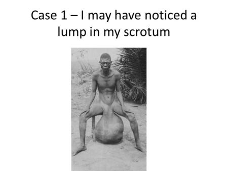 Case 1 – I may have noticed a lump in my scrotum