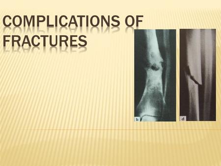 COMPLICATION OF FRACTURE GeneralLocal Early Late.