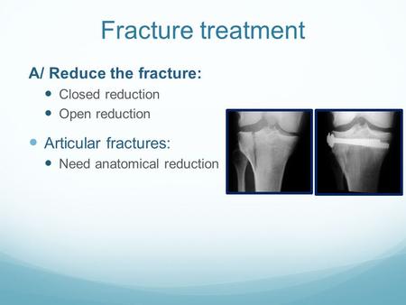 Fracture treatment A/ Reduce the fracture: Closed reduction Open reduction Articular fractures: Need anatomical reduction.