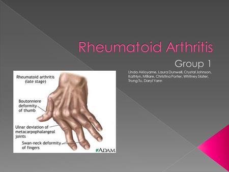 Rheumatoid arthritis az orrán. A rheumatoid arthritis tünetei