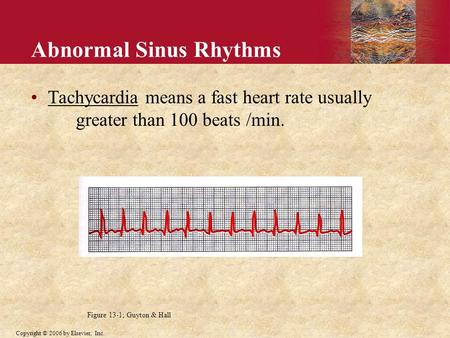 Abnormal Sinus Rhythms