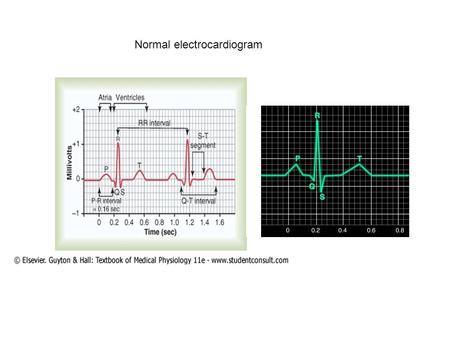 Normal electrocardiogram
