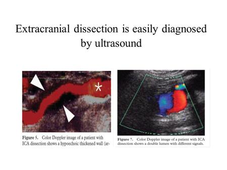 Extracranial dissection is easily diagnosed by ultrasound.