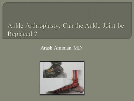 Ankle Arthroplasty: Can the Ankle Joint be Replaced ?
