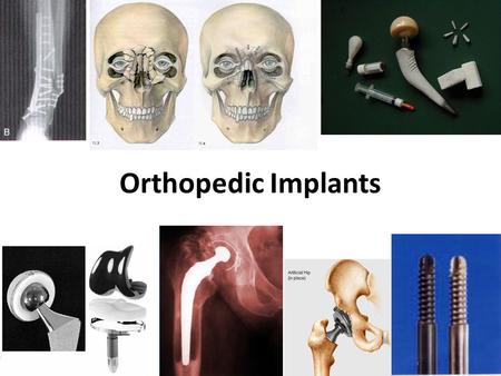 Orthopedic Implants. Orthopedic Prosthetics & Implants Ankles, Heels & Toes Prostheses Bone Cements & Fillers Bone Fixators Collagens & Bone Grafts.