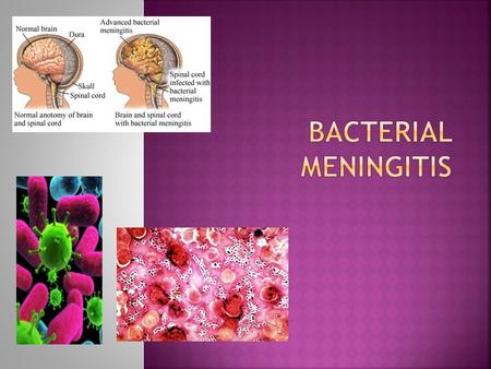 Bacterial Meningitis.