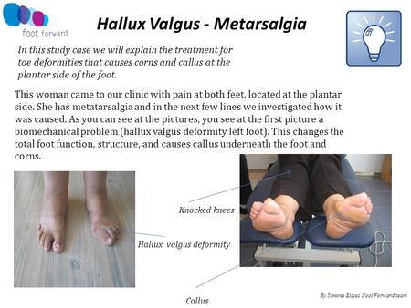 By Simone Eisses Foot Forward team Hallux Valgus - Metarsalgia In this study case we will explain the treatment for toe deformities that causes corns and.