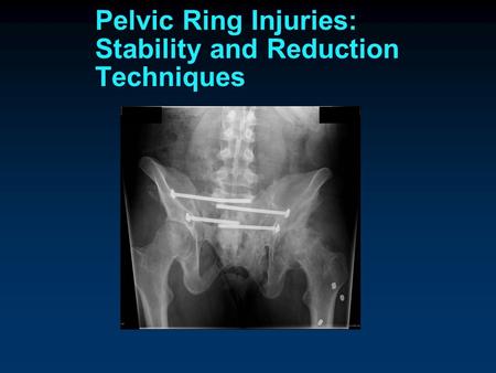 Pelvic Ring Injuries Classification of Pelvic Ring Injuries