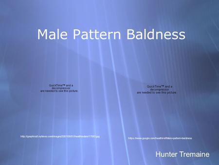 Male Pattern Baldness Hunter Tremaine  https://www.google.com/health/ref/Male+pattern+baldness.