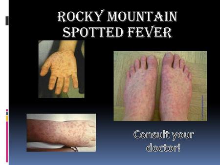 Rocky Mountain Spotted Fever. Description  A tick-borne bacterial disease called Rickettsia, causes vessels to leak. It affects the cells in the lining.