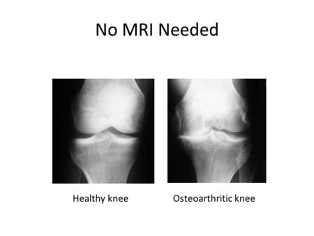 No MRI Needed Osteoarthritic kneeHealthy knee. Burden of Disease 39.4 million visits to physicians offices 750,000 hospitalizations OA cost $125 billion/year.