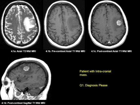 4.1b. Pre-contrast Axial T1 Wtd MRI4.1c. Post-contrast Axial T1 Wtd MRI4.1a. Axial T2 Wtd MRI 4.1d. Post-contrast Sagittal T1 Wtd MRI Patient with Intra-cranial.
