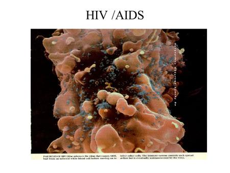 HIV /AIDS.