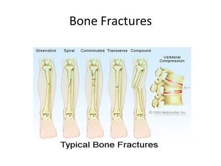 Bone Fractures.
