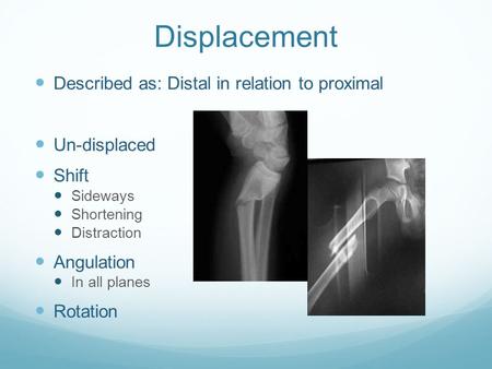 Displacement Described as: Distal in relation to proximal Un-displaced Shift Sideways Shortening Distraction Angulation In all planes Rotation.