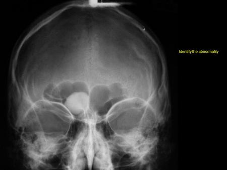 Identify the abnormality. Depicts a growth in the right frontal sinus.