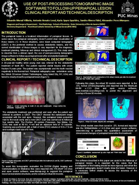 REFERENCES INTRODUCTION The periapical lesion is a localized inflammation of periapical tissues. In some cases the periapical radiography doesn’t permit.