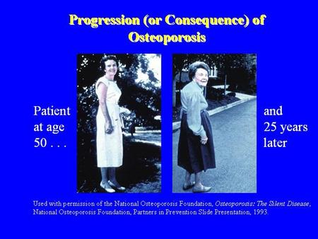 Pathogenesis of Osteoporotic Fracture LOW PEAK BONE MASS LOW PEAK BONE MASS POSTMENOPAUSAL BONE LOSS POSTMENOPAUSAL BONE LOSS AGE-RELATED BONE LOSS.