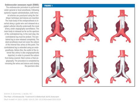 Greiner, A; Grommes, J; Jacobs, M J The Place of Endovascular Treatment in Abdominal Aortic Aneurysm Dtsch Arztebl Int 2013; 110(8): 119-25; DOI: 10.3238/arztebl.2013.0119.