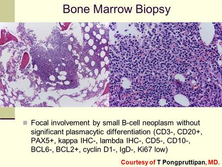 Bone Marrow Biopsy Focal involvement by small B-cell neoplasm without significant plasmacytic differentiation (CD3-, CD20+, PAX5+, kappa IHC-, lambda IHC-,