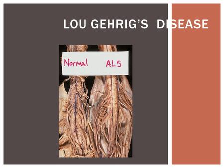 LOU GEHRIG’S DISEASE.  Also known as Amyotrophic Lateral Sclerosis  Is a disease of the nerve cells in the brain and spinal cord that control voluntary.