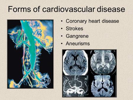 Forms of cardiovascular disease Coronary heart disease Strokes Gangrene Aneurisms.