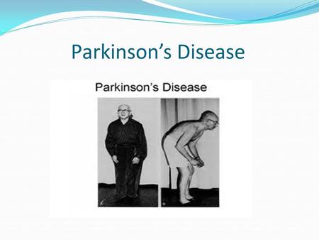 Parkinson’s Disease. Definition Parkinson's disease (PD) is an idiopathic, slowly progressive, neurodegenerative disorder whereby two or more of the following.