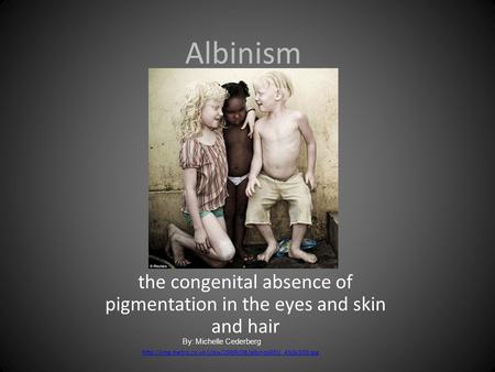Albinism the congenital absence of pigmentation in the eyes and skin and hair  By: Michelle.