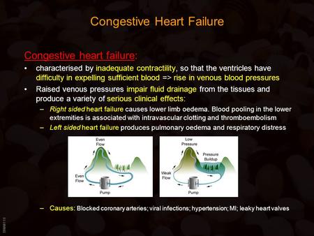 BIMM118 Congestive Heart Failure Congestive heart failure: characterised by inadequate contractility, so that the ventricles have difficulty in expelling.