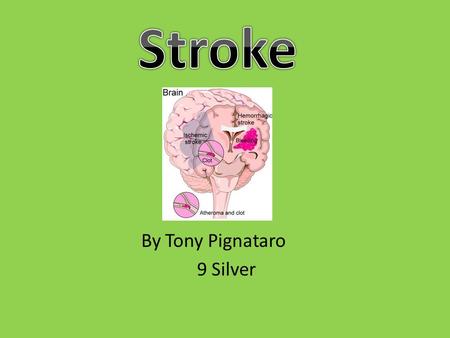 By Tony Pignataro 9 Silver. Two types of stroke ischaemic and haemorrhagic are the two types of stroke. A stroke is the sudden loss of function to the.