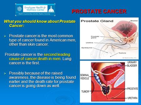PROSTATE CANCER PROSTATE CANCER What you should know about Prostate Cancer:  Prostate cancer is the most common type of cancer found in American men,
