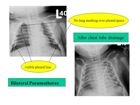 Bilateral Pneumothorax After chest tube drainage visible pleural line No lung marking over pleural space.