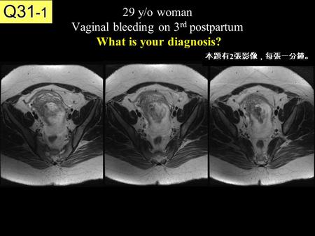 29 y/o woman Vaginal bleeding on 3 rd postpartum What is your diagnosis? Q31 -1 本題有 2 張影像，每張一分鐘。
