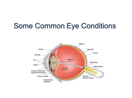 Some Common Eye Conditions. Blepharitis BlepharitisAnterior Posterior.