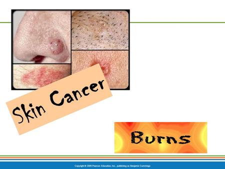Copyright © 2009 Pearson Education, Inc., publishing as Benjamin Cummings Skin Cancer.