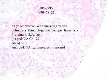 U06-7995 #904681210 53 yr old woman with sinusitis,arthritis pulmonary hemorrhage,microscopic hematuria Proteinuria 2.5g/day (+) pANCA,Cr 127 ANA(+). Anti.