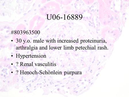 U06-16889 #803963500 30 y.o. male with increased proteinuria, arthralgia and lower limb petechial rash. Hypertension ? Renal vasculitis ? Henoch-Schönlein.