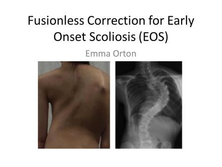 Fusionless Correction for Early Onset Scoliosis (EOS) Emma Orton BME 281.
