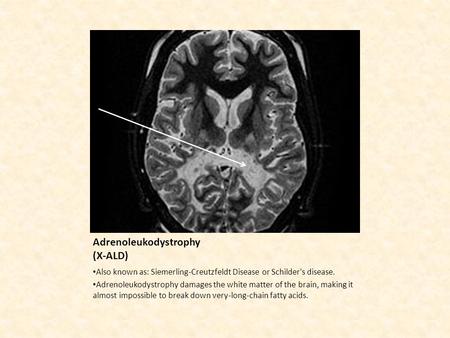 Adrenoleukodystrophy (X-ALD)