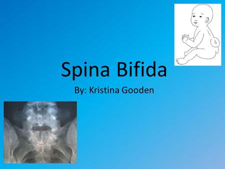 Spina Bifida By: Kristina Gooden.