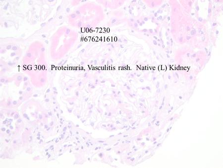U06-7230 #676241610 ↑ SG 300. Proteinuria, Vasculitis rash. Native (L) Kidney.
