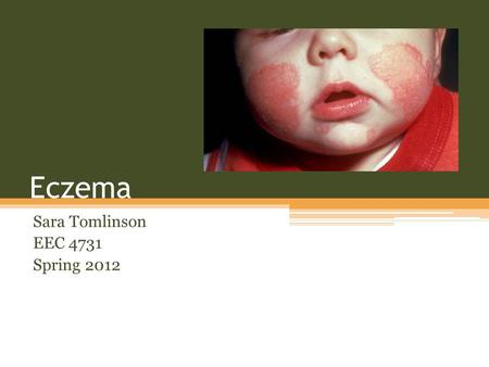 Eczema Sara Tomlinson EEC 4731 Spring 2012. Overview Eczema is a inflammatory skin condition which causes the skin to become inflamed of irritated. Eczema.