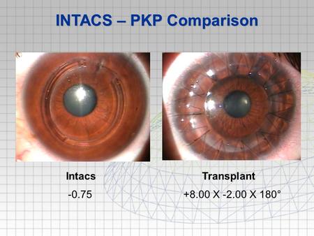INTACS – PKP Comparison +8.00 X -2.00 X 180°-0.75 TransplantIntacs.